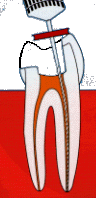 ENDO1[1]